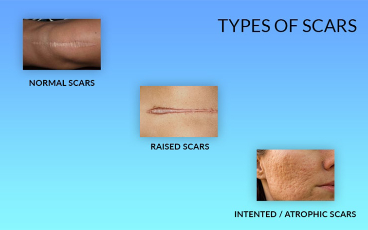 Scars Types
