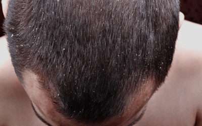 How to Get Rid of Dandruff?