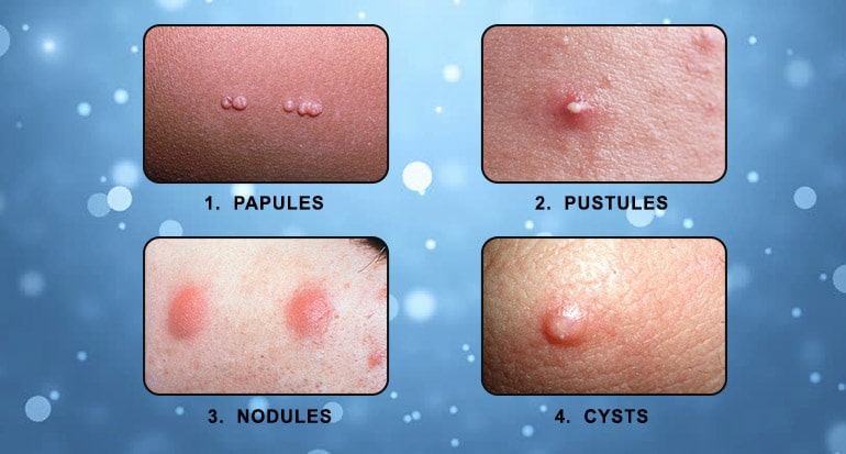 Inflammatory acne is responsible for papules, pustules, cysts, and nodules.