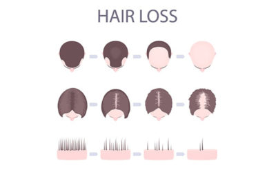 3 Popluar Types of Hair Loss Treatments [Select the best One]