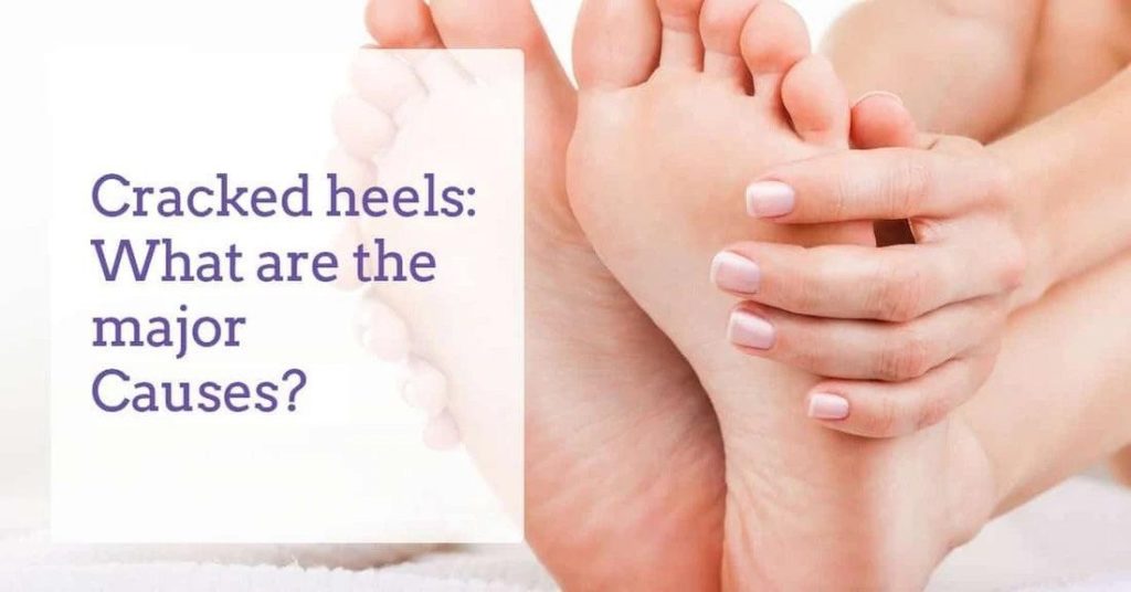 Causes of Cracked Heels - Dr. Venus