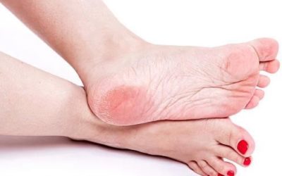 How to Prevent Cracked Heels?