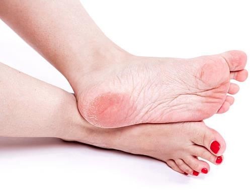 How to Prevent Cracked Heels?