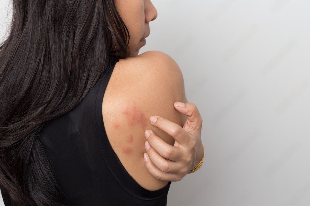Can Stress Cause Rashes?