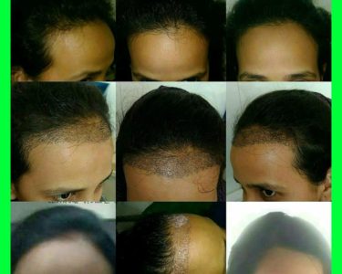 Female-hair-transplant 1