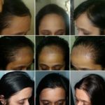 Fue-Hair-transplant-for-women