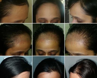 Fue-Hair-transplant-for-women