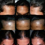 Best Hair Loss Treatment in Hyderabad  Hair Fall Treatment Cost Procedure   Side Effects
