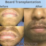 beard-transplantation