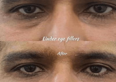 Eye Fillers