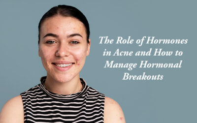 The Role of Hormones in Acne and How to Manage Hormonal Breakouts