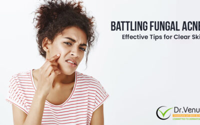 Battling Fungal Acne: Effective Tips for Clear Skin