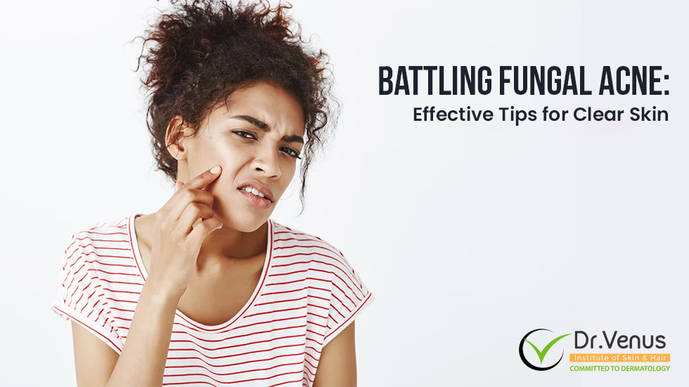 Battling Fungal Acne: Effective Tips for Clear Skin