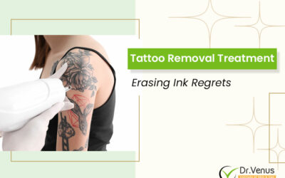 Tattoo Removal Treatment: Erasing Ink Regrets