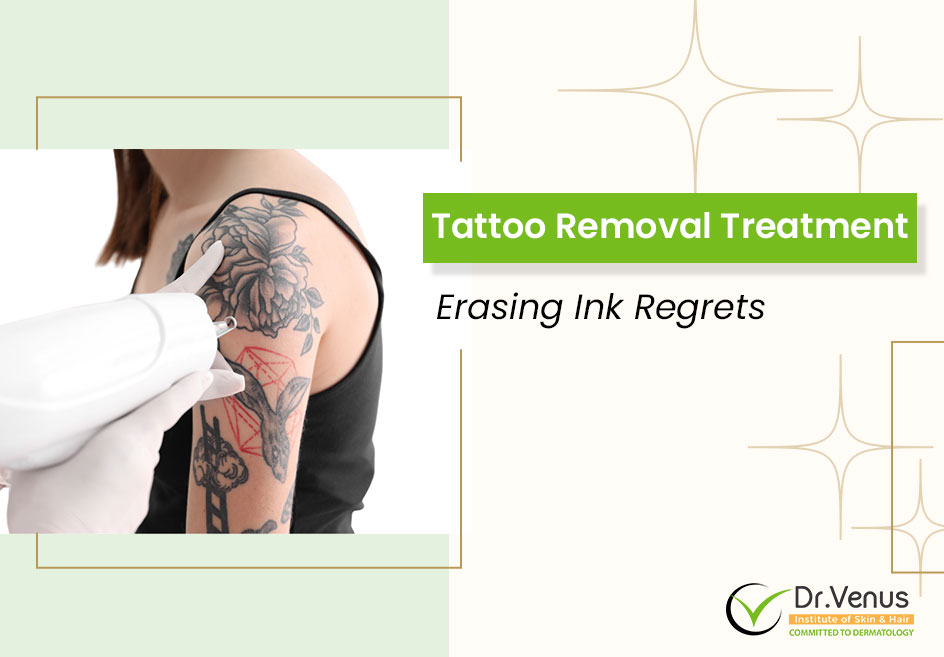 Tattoo Removal Treatment: Erasing Ink Regrets