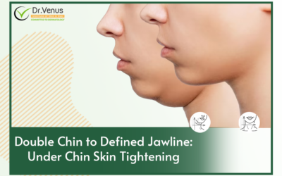 Double Chin to Defined Jawline: Under Chin Skin Tightening 