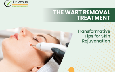 The Wart Removal Treatment: Transformative Tips for Skin Rejuvenation