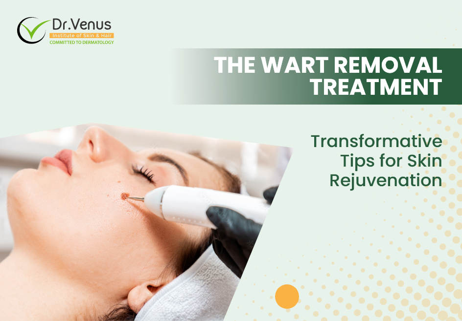 wart removal treatment