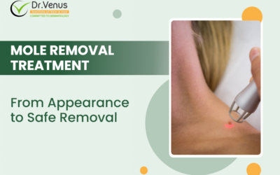 Mole Removal Treatment: From Appearance to Safe Removal 