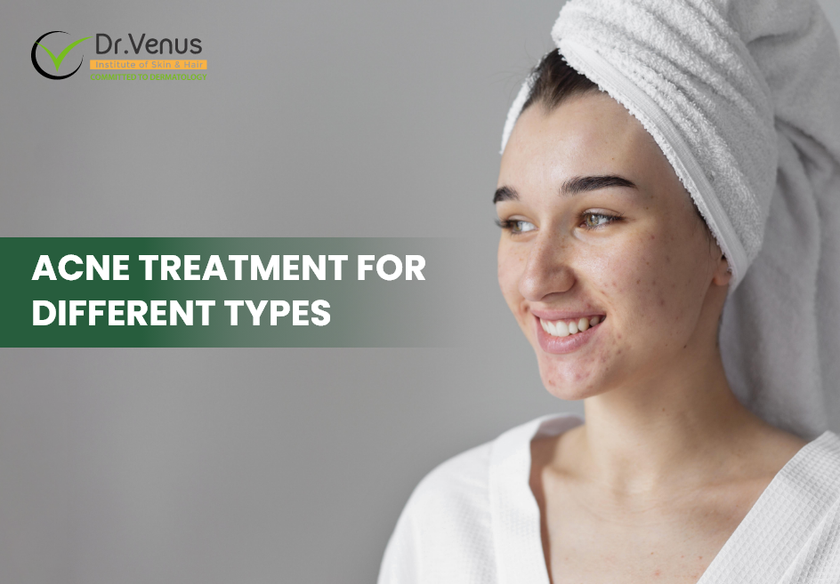 Different types of acne treatment