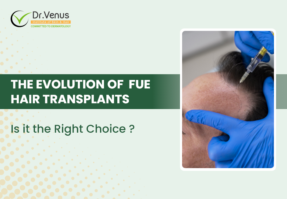 The Evolution of  FUE Hair Transplants: Is it the Right Choice in 2024?