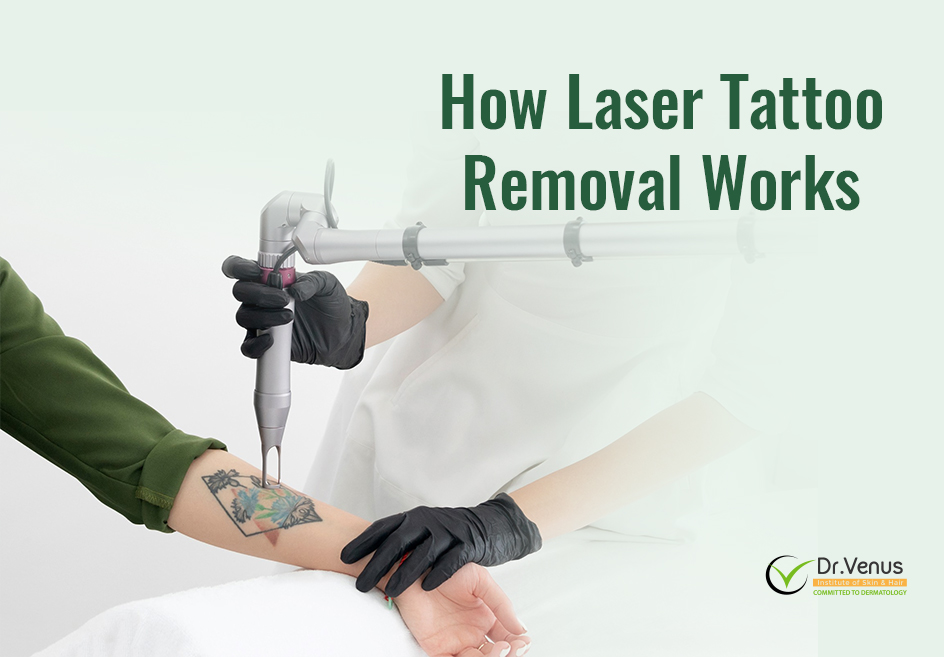 Behind the Beam: How Laser Tattoo Removal Works