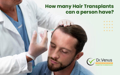 How many Hair Transplants can a person have?